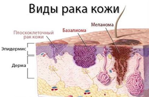Профилактика меланомы и рака кожи. Как уменьшить риск